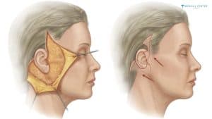 Why Deep Plane Facelifts are Trending?