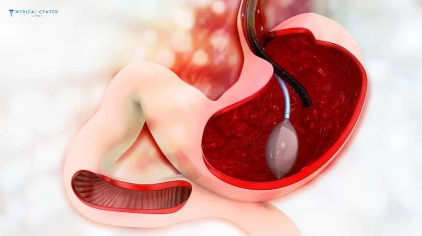 Is the Gastric Balloon Right for You?