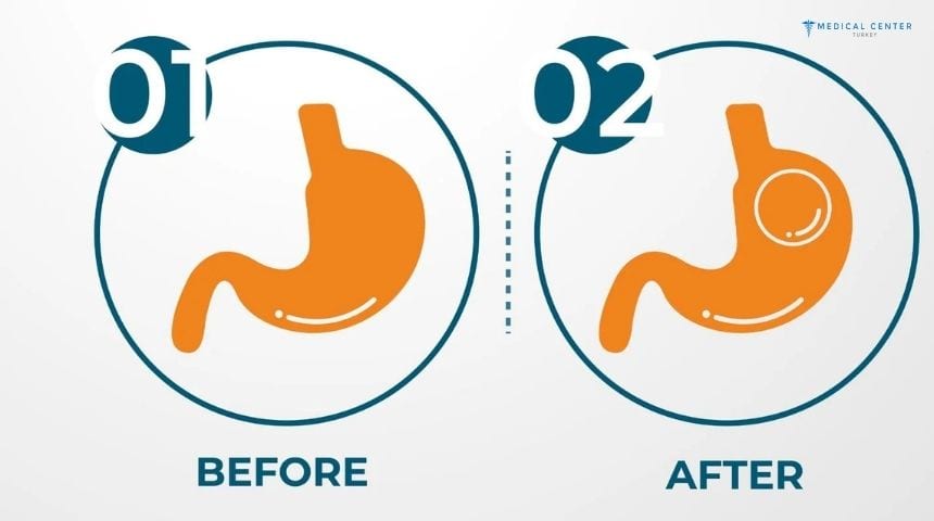 Is the Gastric Balloon Right for You?