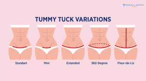 Which Tummy Tuck Option Should You Consider in 2026?