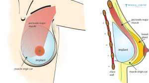 Why Breast Augmentations Deliver Perfect Result in Turkey?