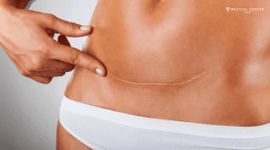 Which Tummy Tuck Option Should You Consider in 2026?