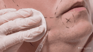 What to Expect From Jawline in Turkey