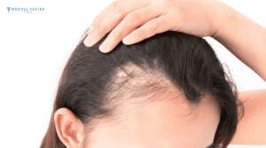 What’s the Best Hair Loss Solution in 2026