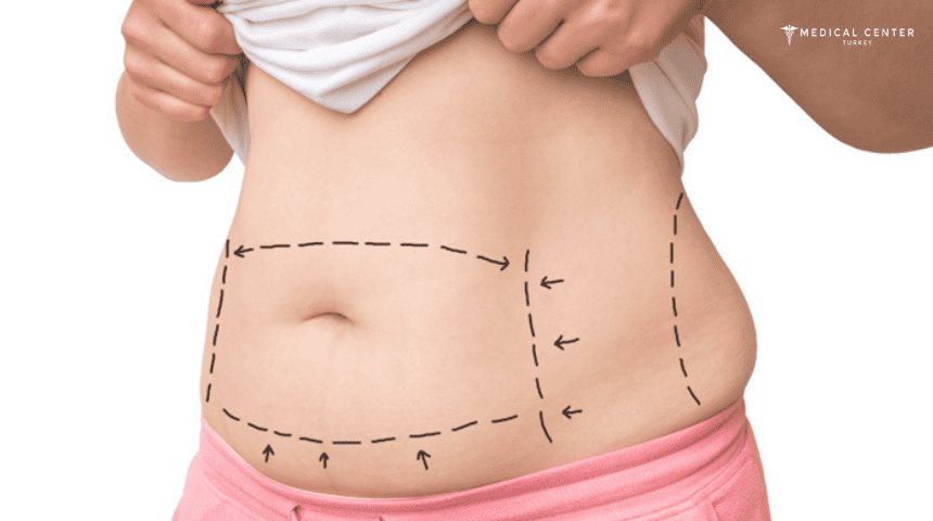 Which Tummy Tuck Option Should You Consider in 2026?