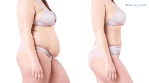 Which Tummy Tuck Option Should You Consider in 2026?