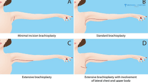 How Arm Lift Surgery Is Evolving in Turkey?