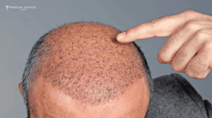 What’s the Best Hair Loss Solution in 2026