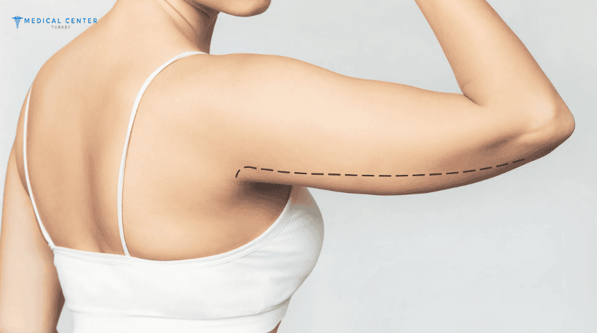 How Arm Lift Surgery Is Evolving in Turkey?