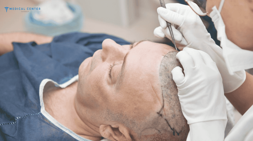 Top Reasons to Choose Turkey for Your Hair Transplant
