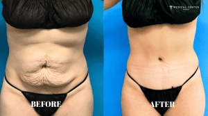 Which Tummy Tuck Option Should You Consider in 2026?