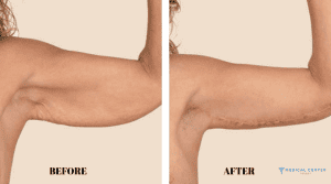 How Arm Lift Surgery Is Evolving in Turkey?