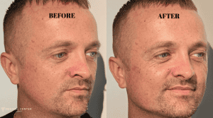 What to Expect From Jawline in Turkey