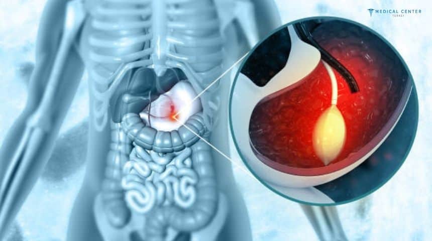 Is the Gastric Balloon Right for You?