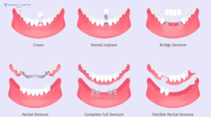 Transform Your Smile With Dent Restoration