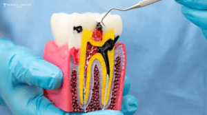 Transform Your Smile With Dent Restoration