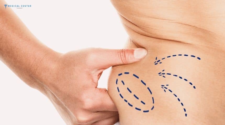 How Liposuction Changes Your Body in Weeks?