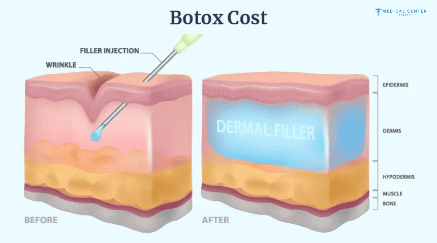 New Botox Alternatives in Turkey