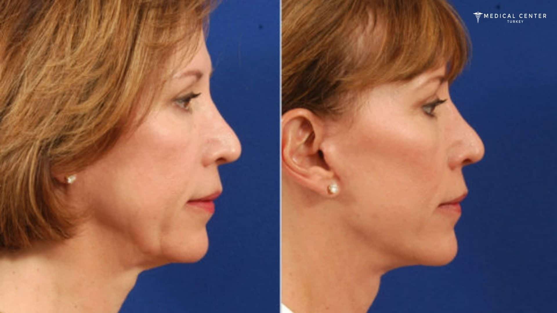 What Changes Can Be Expected After Facelift Surgery?