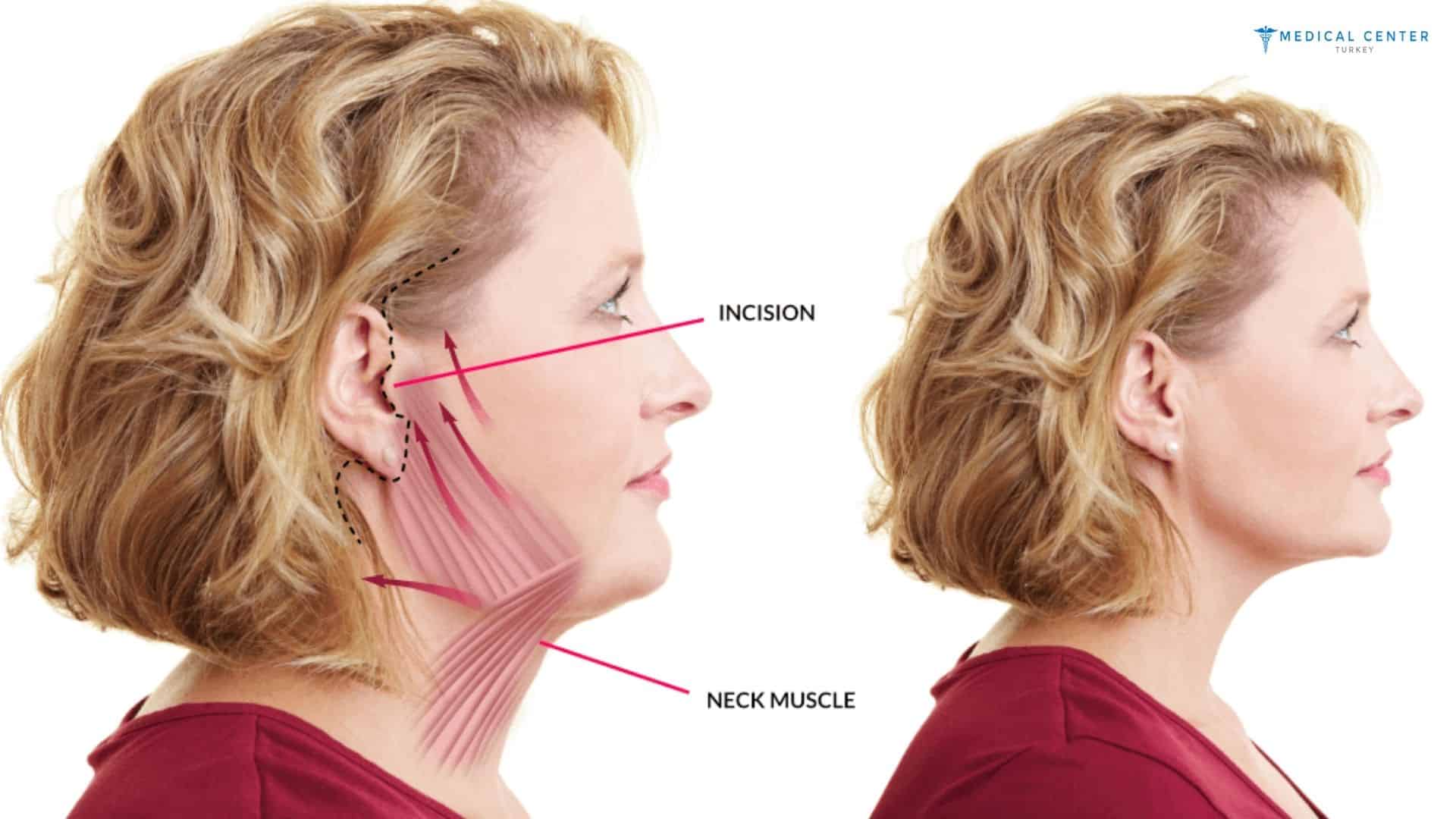 What Changes Can Be Expected After Facelift Surgery?