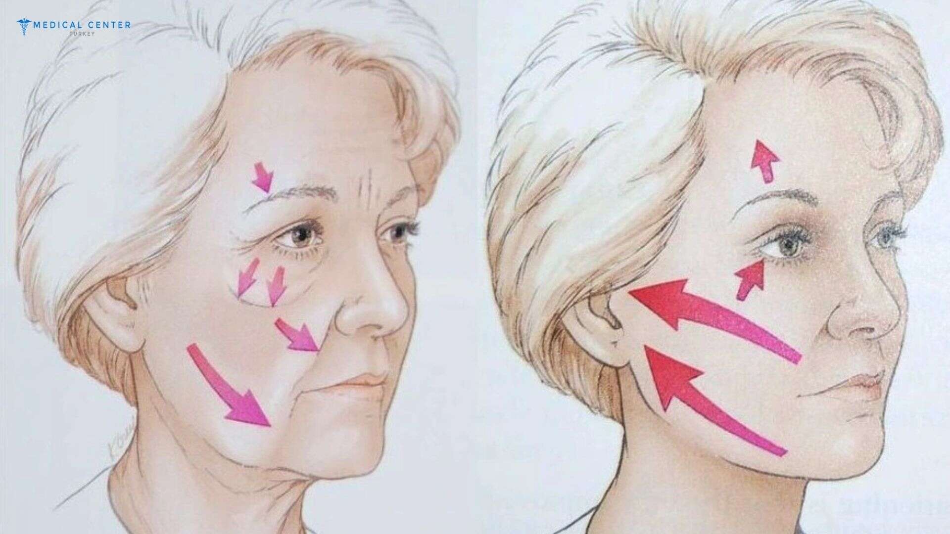 What Changes Can Be Expected After Facelift Surgery?