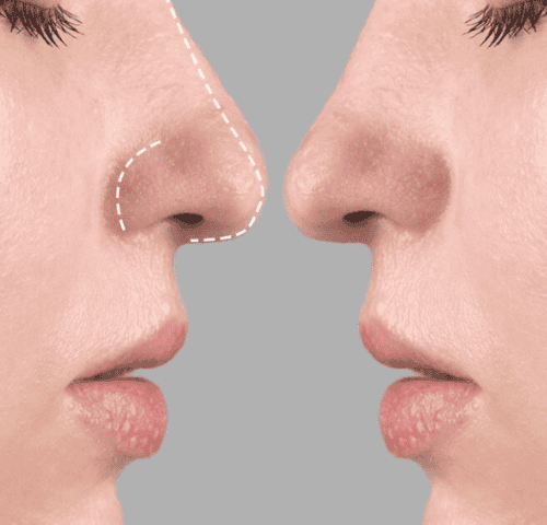 When Will You See the Shape of Your Nose After Rhinoplasty?