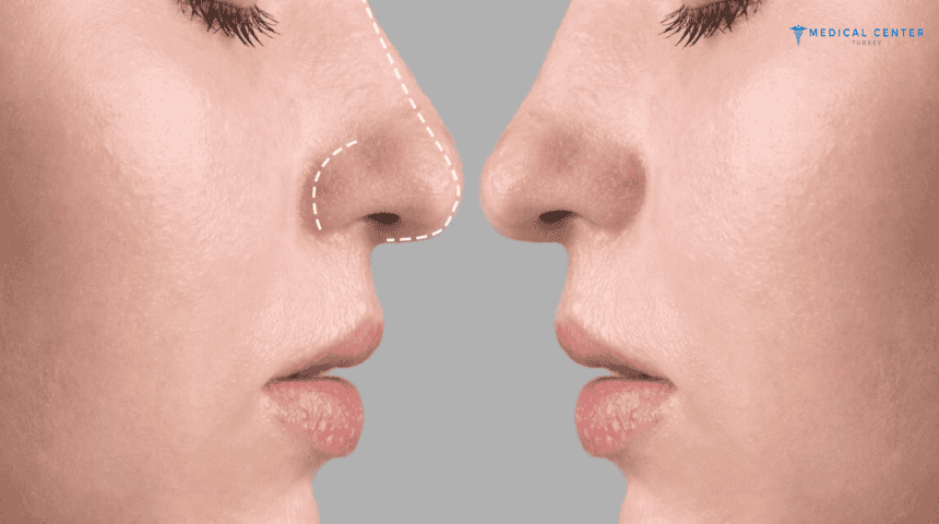 When Will You See the Shape of Your Nose After Rhinoplasty? When Will You See the Shape of Your Nose After Rhinoplasty?