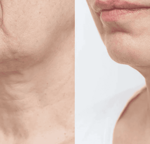 What Long Term Result Should You Expected Before and After Neck Lift? What Long Term Result Should You Expected Before and After Neck Lift?