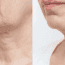 What Long Term Result Should You Expected Before and After Neck Lift?