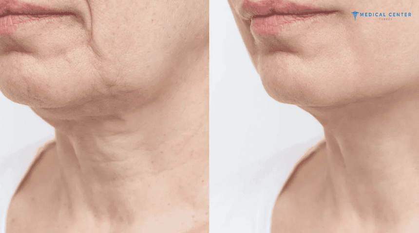 What Long Term Result Should You Expected Before and After Neck Lift? What Long Term Result Should You Expected Before and After Neck Lift?