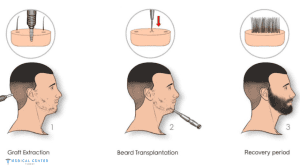 Beard Transplants Tips for Natural Looking Results