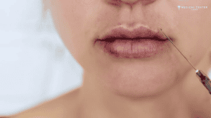 How Long Do Lip Filler Last?