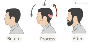 Beard Transplants Tips for Natural Looking Results