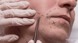 Beard Transplants Tips for Natural Looking Results