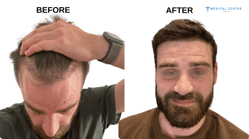 Jonathan Wickens Hair Transplant Experiences in Turkey