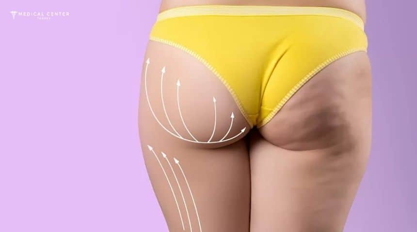 BBL Recovery Timeline Explained Week by Week