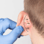 Ear Correction Surgery (Otoplasty) Who Is a Good Candidate?