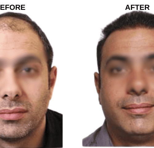 Joseph’s Hair Transplant Experiences in Turkey Joseph’s Hair Transplant Experiences in Turkey