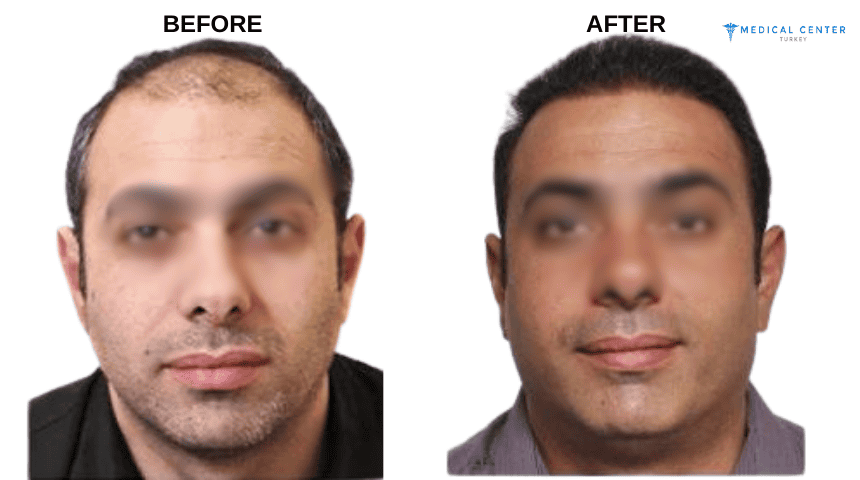Joseph’s Hair Transplant Experiences in Turkey