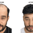 Roman’s Hair Transplant Experiences in Turkey