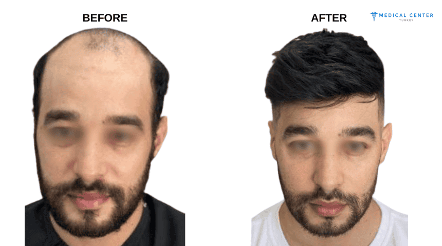Roman’s Hair Transplant Experiences in Turkey Roman’s Hair Transplant Experiences in Turkey