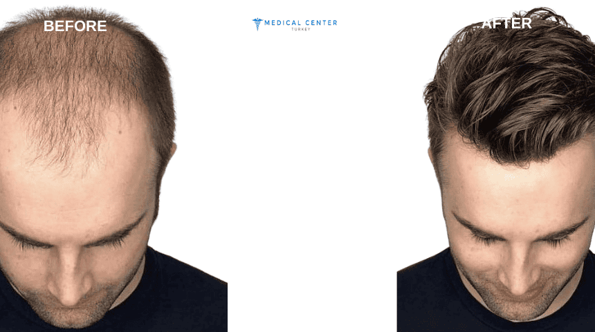 Micheal's Hair Transplant Experiences in Turkey