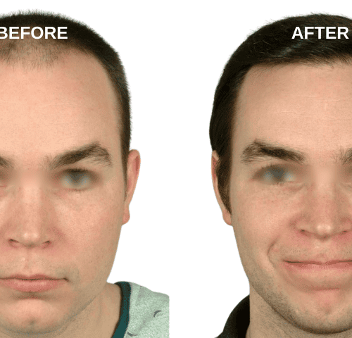 Jun Clapano Hair Transplant Experiences in Turkey