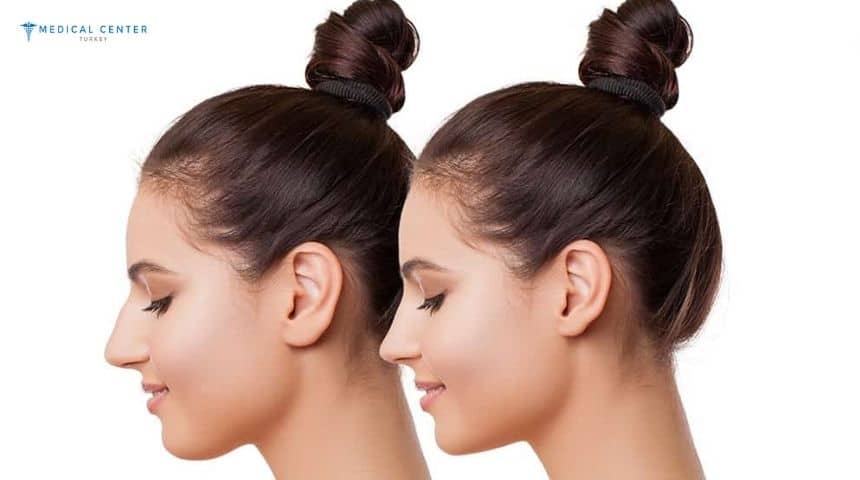 Rhinoplasty Surgery to Improve Facial Balance