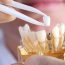 Differences Between Dental Implants and Veneers