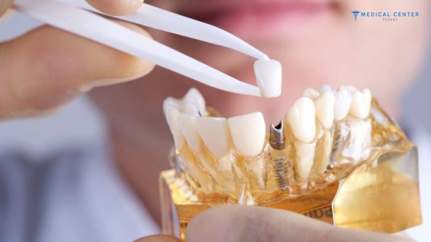 Differences Between Dental Implants and Veneers