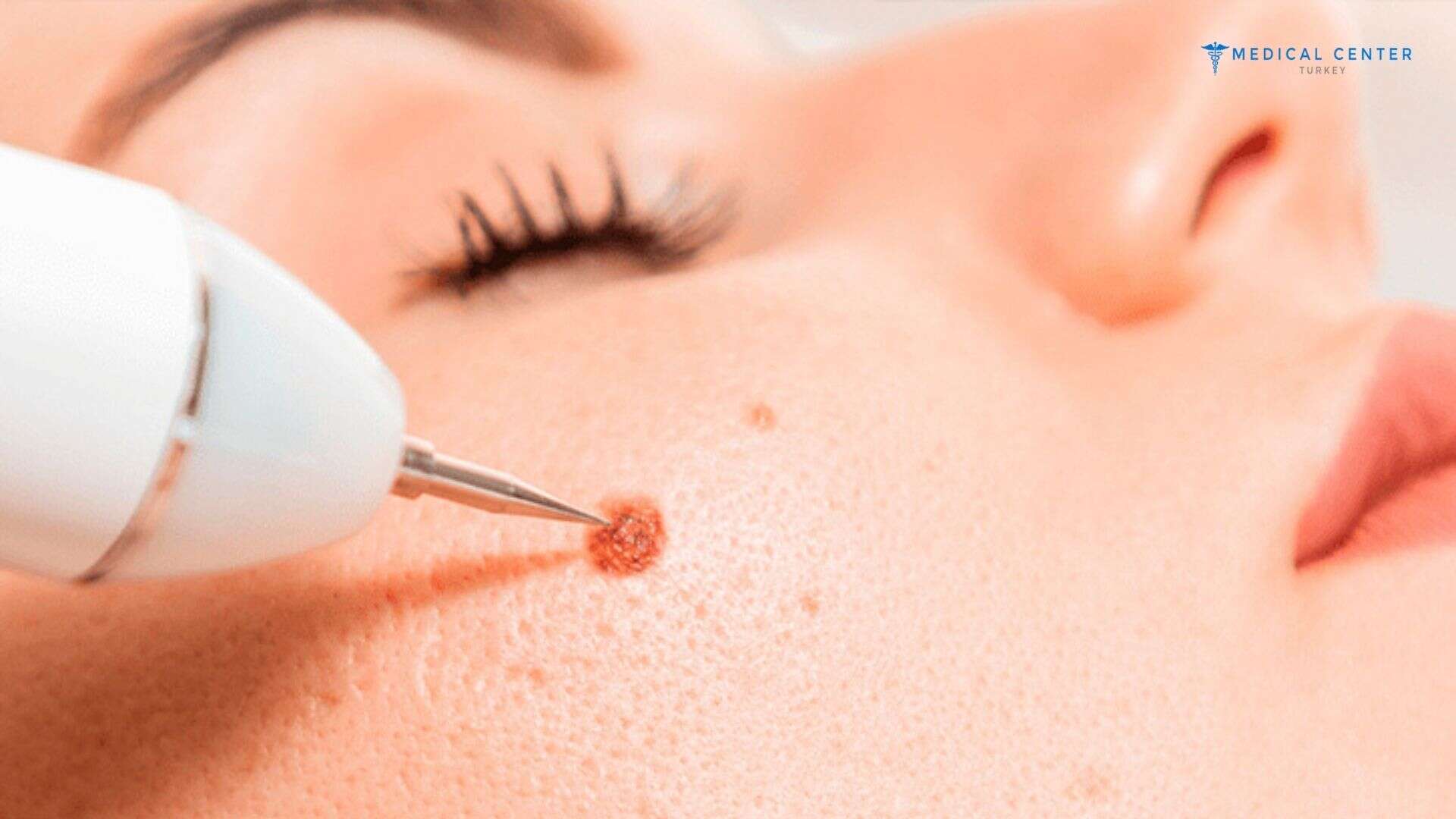 Reasons and Aesthetic Causes for Mole Removal
