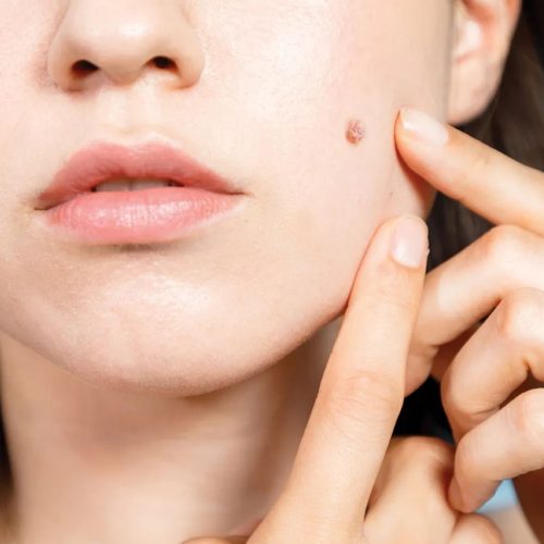 Reasons and Aesthetic Causes for Mole Removal
