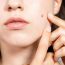 Reasons and Aesthetic Causes for Mole Removal