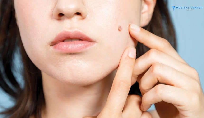 Reasons and Aesthetic Causes for Mole Removal